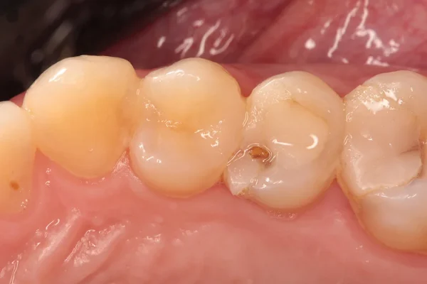 Corona Zirconia Monolitica