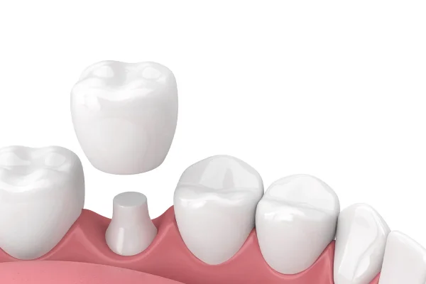 Corona in Ceramica su Zirconioi1