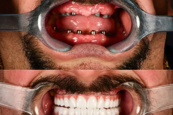 Cost Of Dental Implants In Turkey