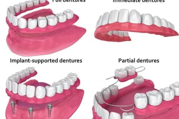 Costi Protesi Dentarie Fisse