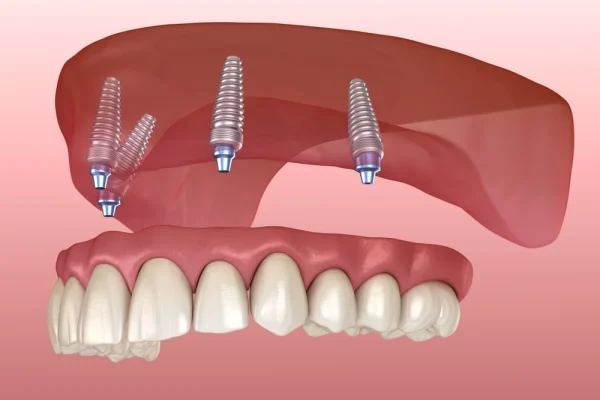 Dental Implants All On Four