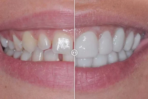 Denti Limati Per Faccette