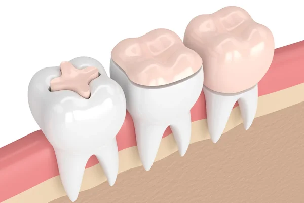 Denti in composito o ceramica2