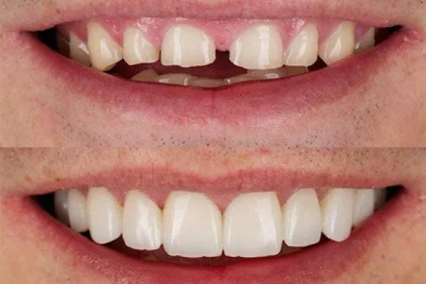 Faccette Ceramica Per Un Sorriso Perfetto