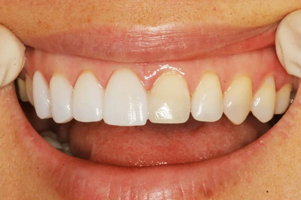 Faccette Estetiche Per Denti