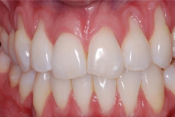 GENGIVE RITIRATE VITAMINE1