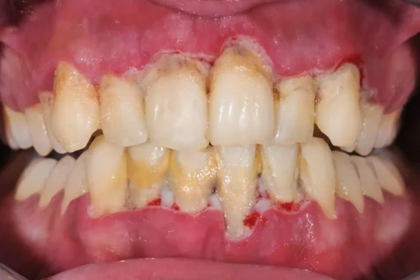 Gingivitis