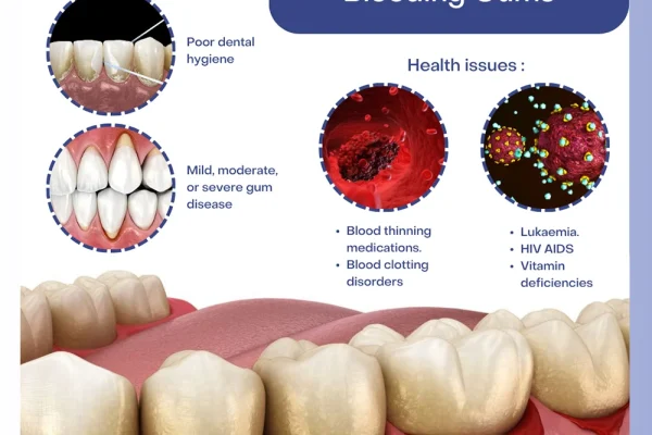 Gum Bleeding
