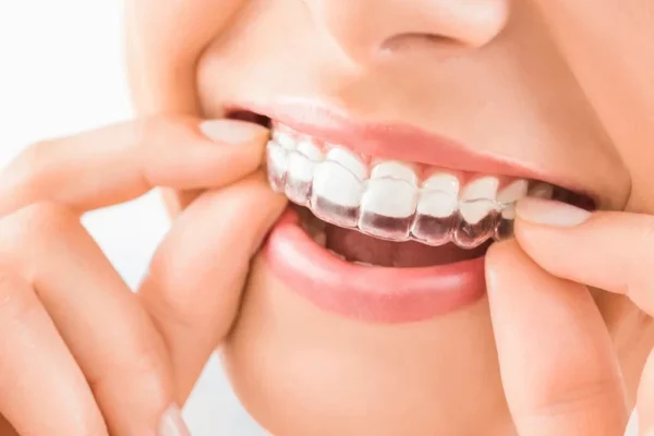 How Much Are Retainers1