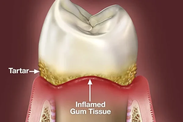 How To Cure Gum Disease Without A Dentist
