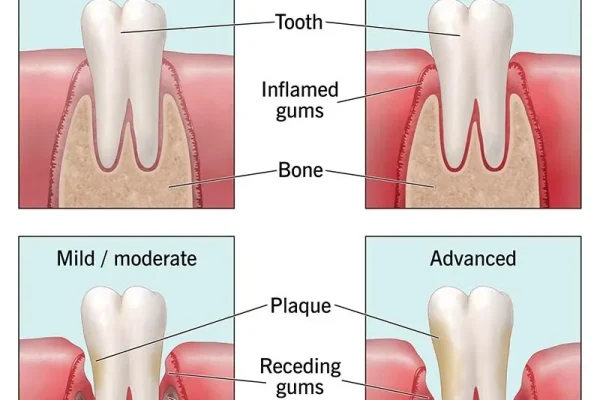 How To Cure Gum Disease