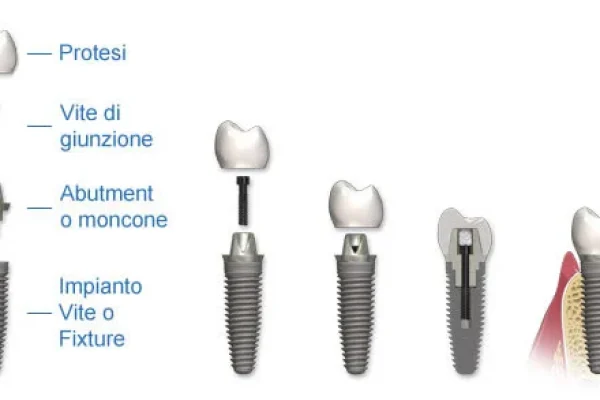 IMPIANTI AL TITANIO DENTI