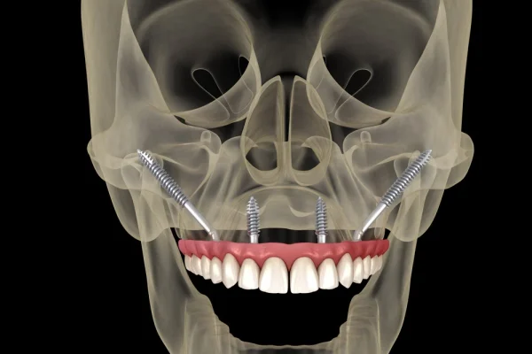 IMPIANTI ZIGOMATICI...1