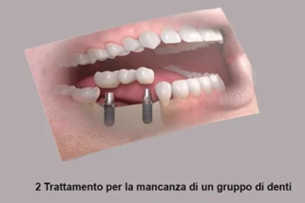 Impianti Per Denti Costi