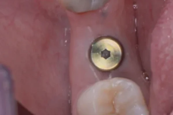 Impianto A Vite Per Denti1