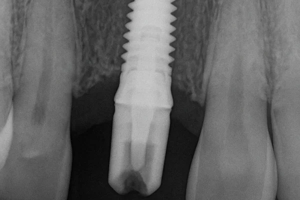 Innesto osseo non riuscito