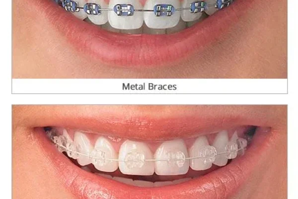Invisible Dental Braces