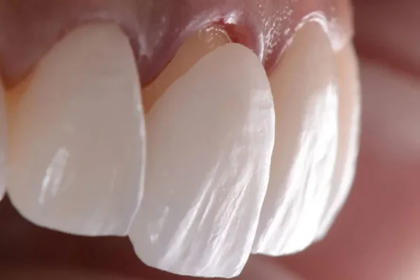 Laminate teeth veneer