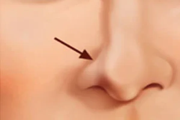 Nostril Collapse