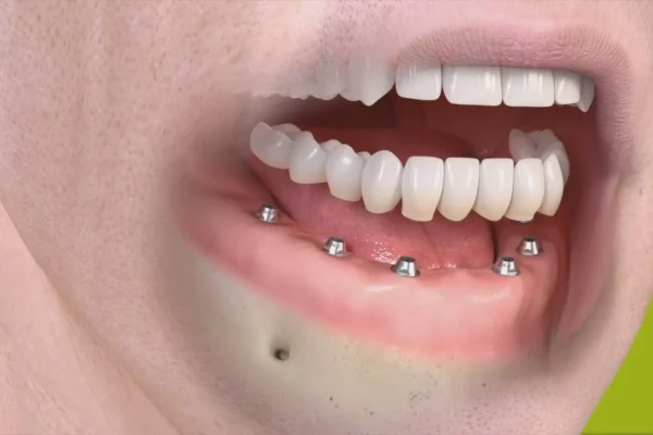 PROTESI DENTARIE FISSE DI ULTIMA GENERAZIONE COSTI1