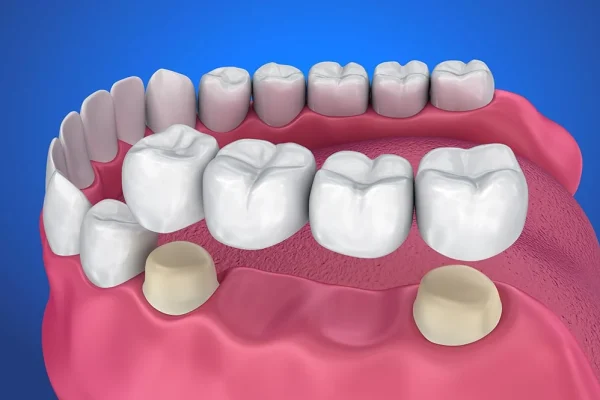 PROTESI DENTARIE MATERIALI1