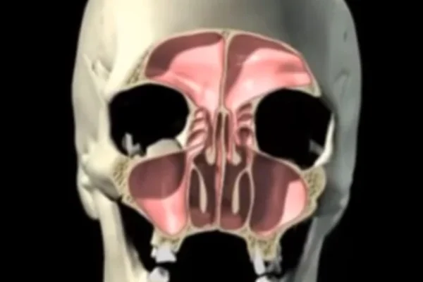 Perforazione Seno Mascellare Sintomi1