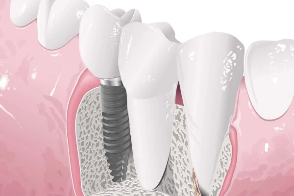 Prezzi Dei Denti In Zirconio