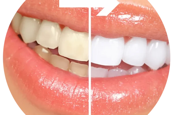 Quanto Costa La Sbiancatura Dei Denti