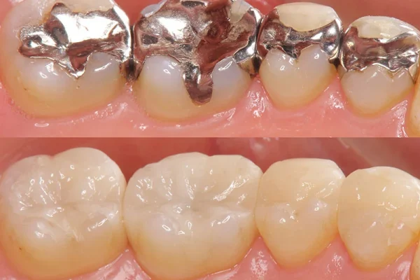 Resina Composita Denti1