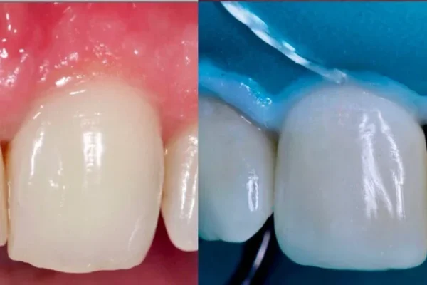 Ricostruire Un Dente1