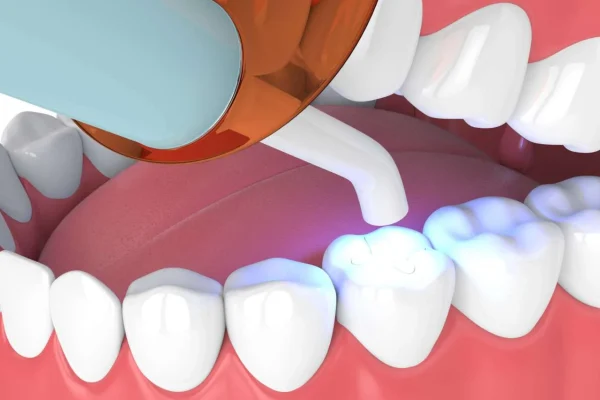 Ricostruzione Dente in Composito Durata