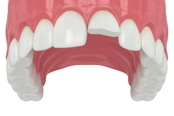 Ricostruzione in Composito3