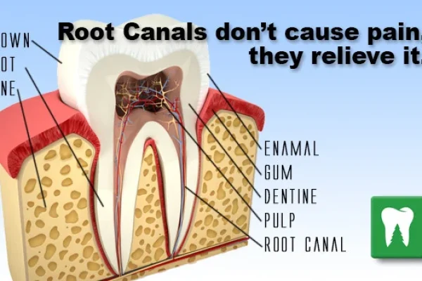 Root Canal And Pain After