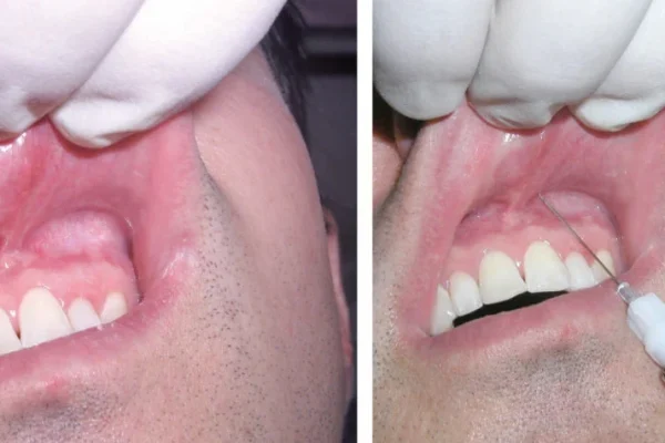 TEETH ANESTHESIA1