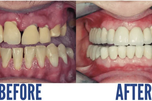 TEETH RECONSTRUCTION1