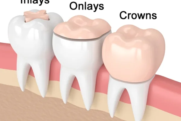 Teeth Inlays And Onlays