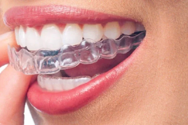 Tooth Straightening1