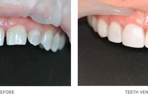 Veneers Price