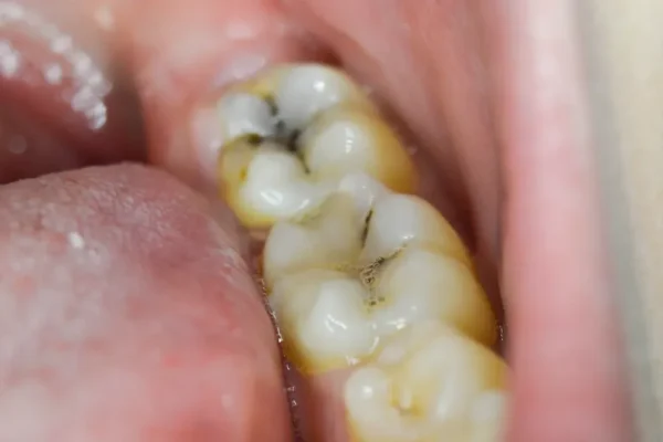 What Do Cavities Look Like1