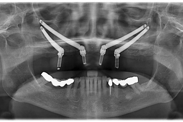 Zygomatic Dental Implants