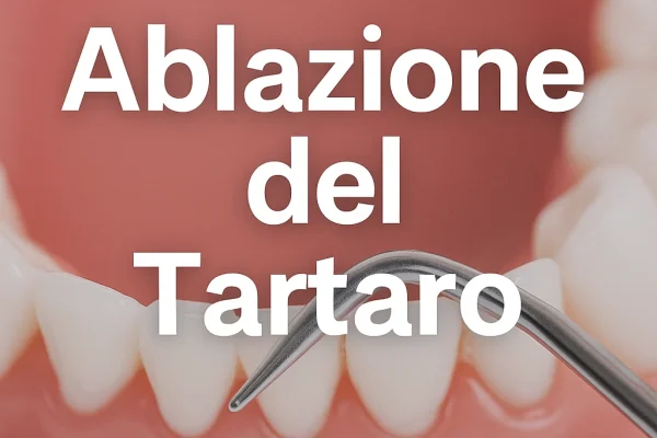 ablazione del tartaro