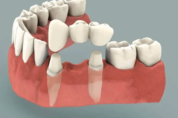 bridge dentistry
