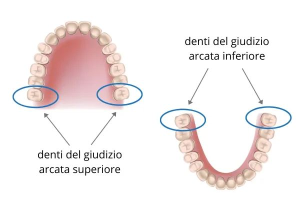 Quando esce il dente del giudizio