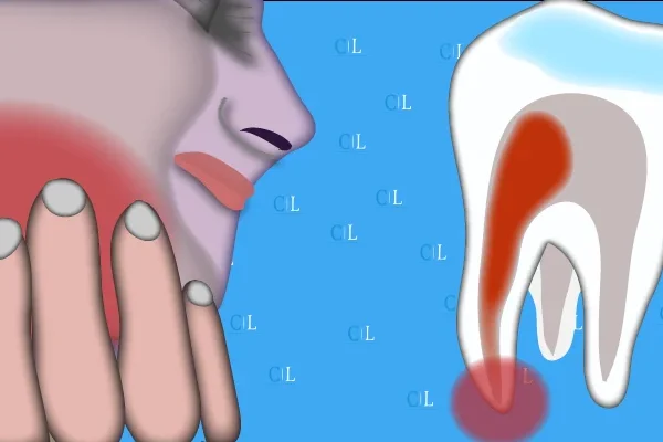Dente da latte caduto con radice