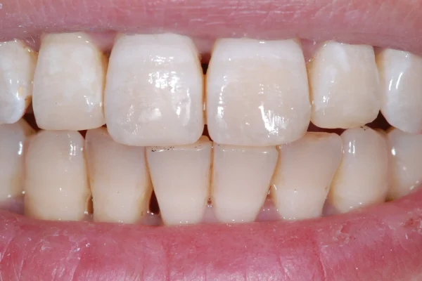 ricostruzione dente4